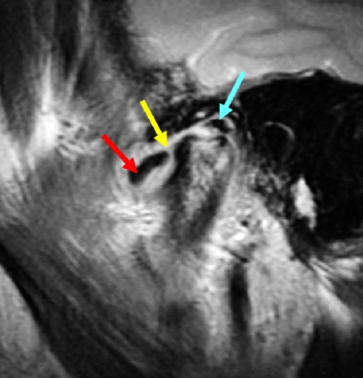 RMN Musculoesquelética